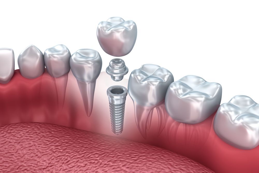 implant supported crowns london ontario